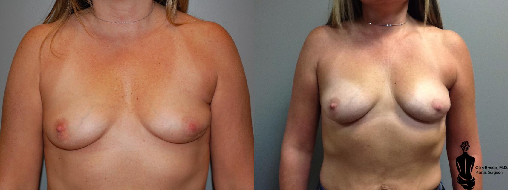 Before & After Breast Reconstruction Case 86 View #2 View in Springfield, MA
