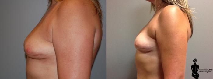 Before & After Breast Reconstruction Case 86 View #4 View in Springfield, MA
