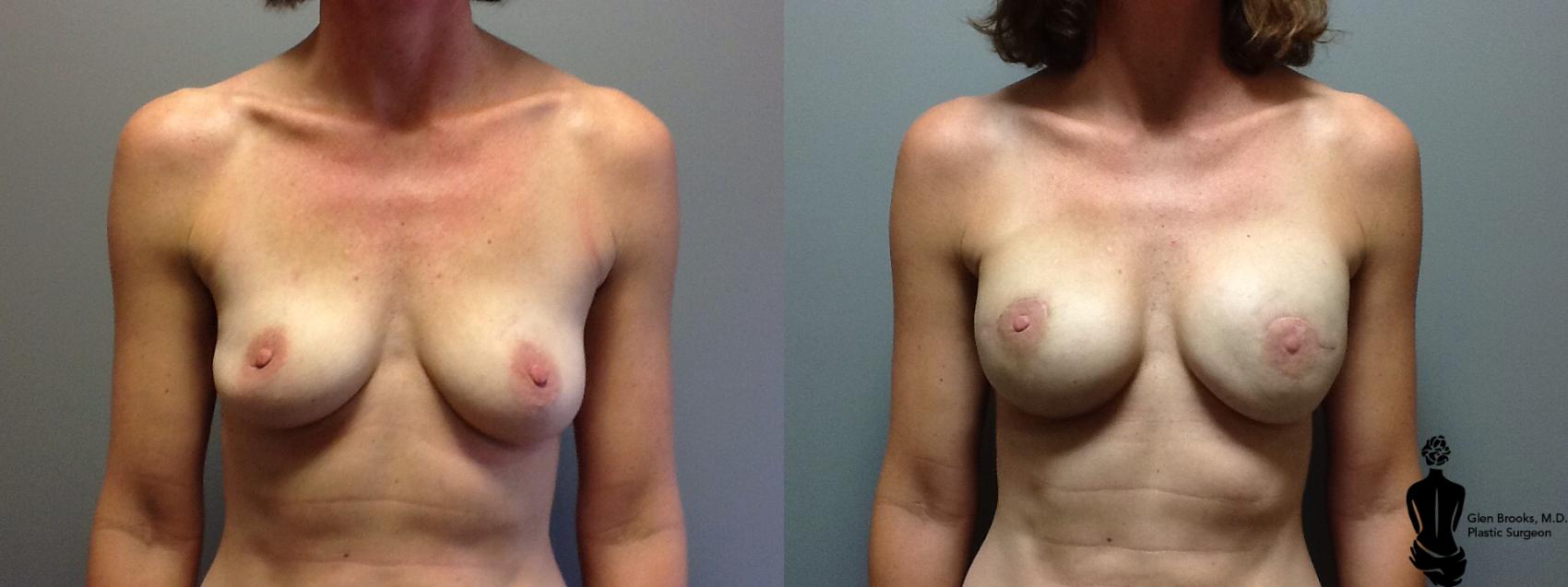 Before & After Breast Reconstruction Case 87 View #1 View in Springfield, MA