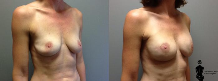 Before & After Breast Reconstruction Case 87 View #2 View in Springfield, MA