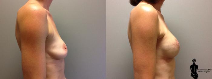 Before & After Breast Reconstruction Case 87 View #3 View in Springfield, MA