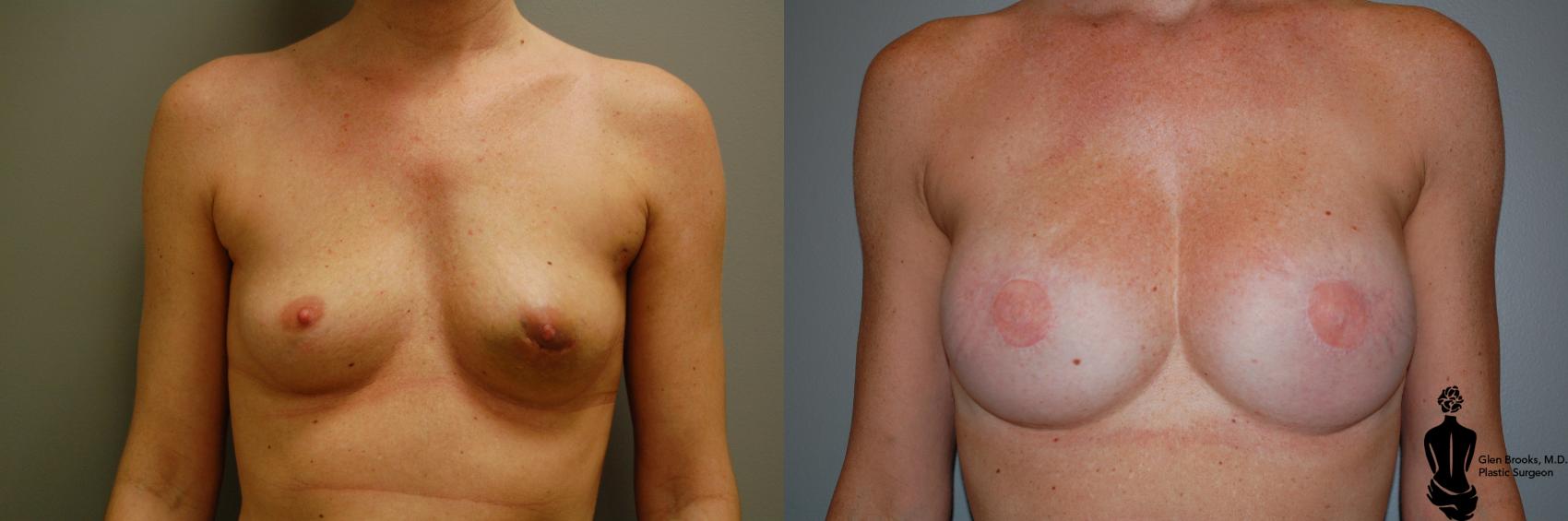 Before & After Breast Reconstruction Case 88 View #1 View in Springfield, MA