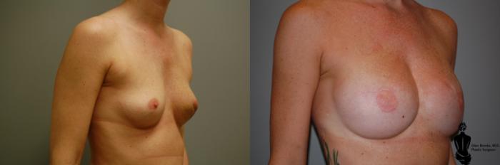 Before & After Breast Reconstruction Case 88 View #2 View in Springfield, MA