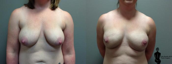 Before & After Breast Reconstruction Case 89 View #1 View in Springfield, MA