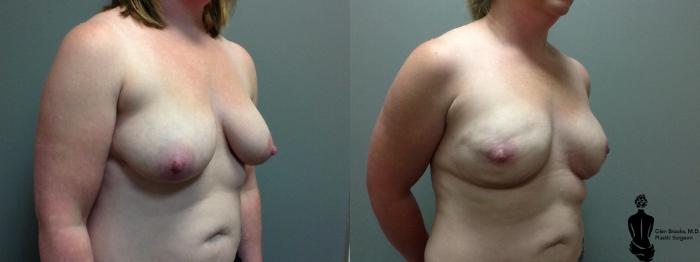 Before & After Breast Reconstruction Case 89 View #2 View in Springfield, MA
