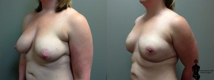 Before & After Breast Reconstruction Case 89 View #3 View in Springfield, MA