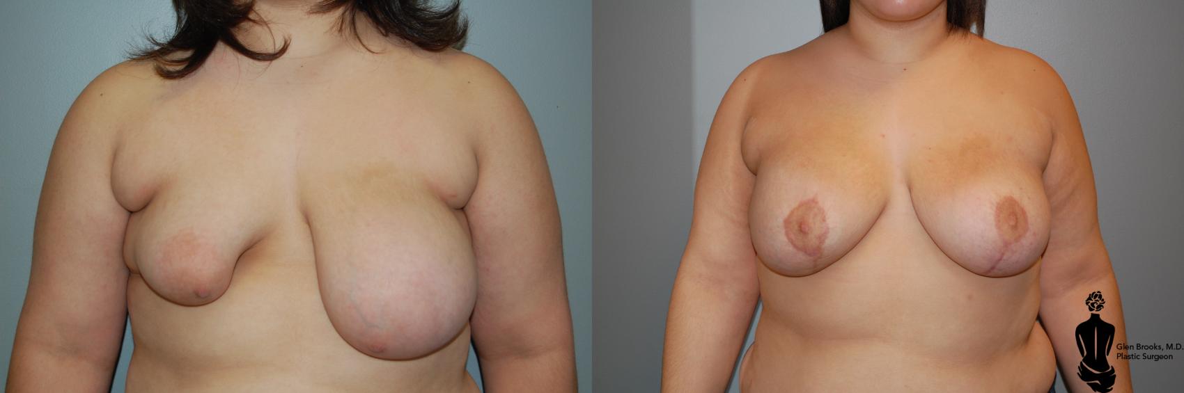 Before & After Breast Reconstruction Case 91 View #1 View in Springfield, MA