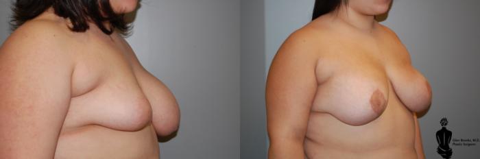 Before & After Breast Reconstruction Case 91 View #2 View in Springfield, MA
