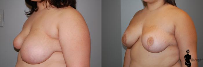 Before & After Breast Reconstruction Case 91 View #3 View in Springfield, MA