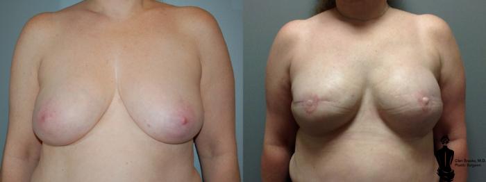 Before & After Breast Reconstruction Case 92 View #2 View in Springfield, MA