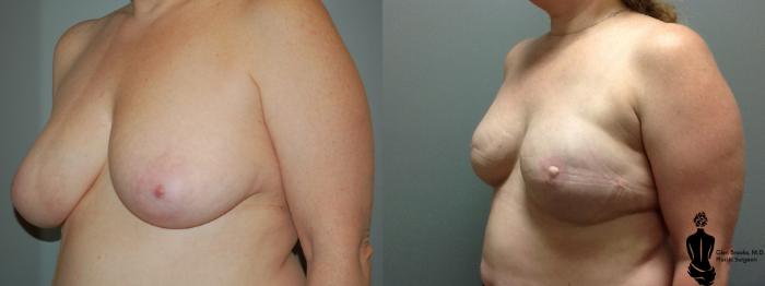 Before & After Breast Reconstruction Case 92 View #3 View in Springfield, MA