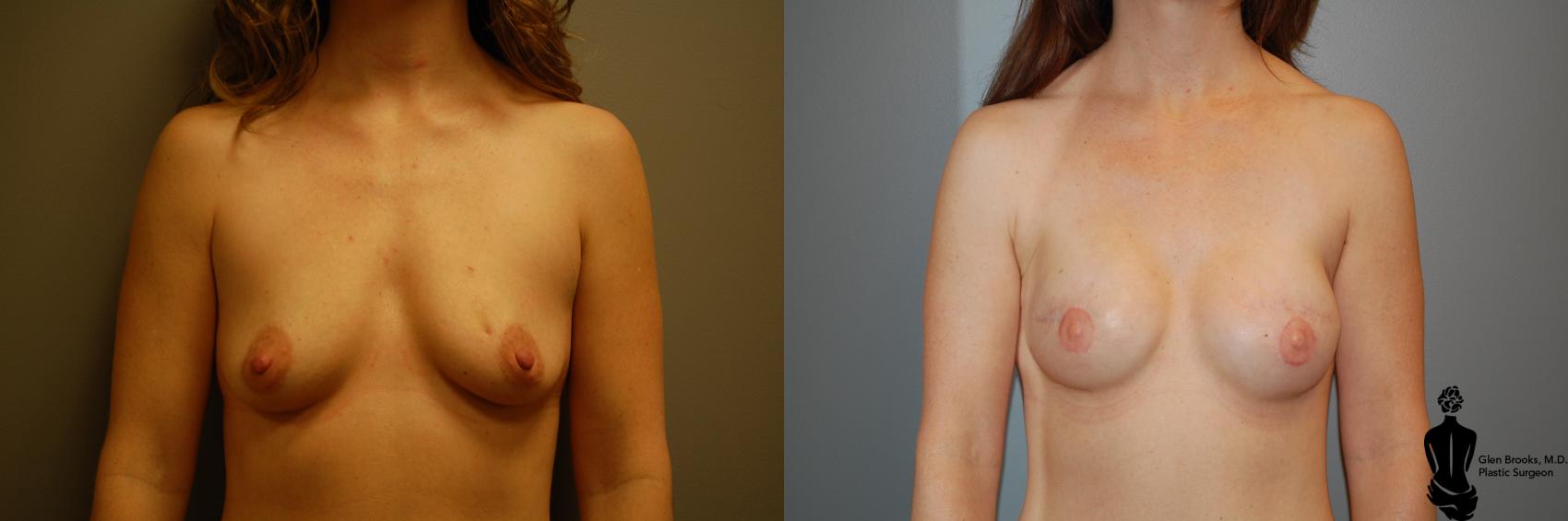Before & After Breast Reconstruction Case 93 View #1 View in Springfield, MA