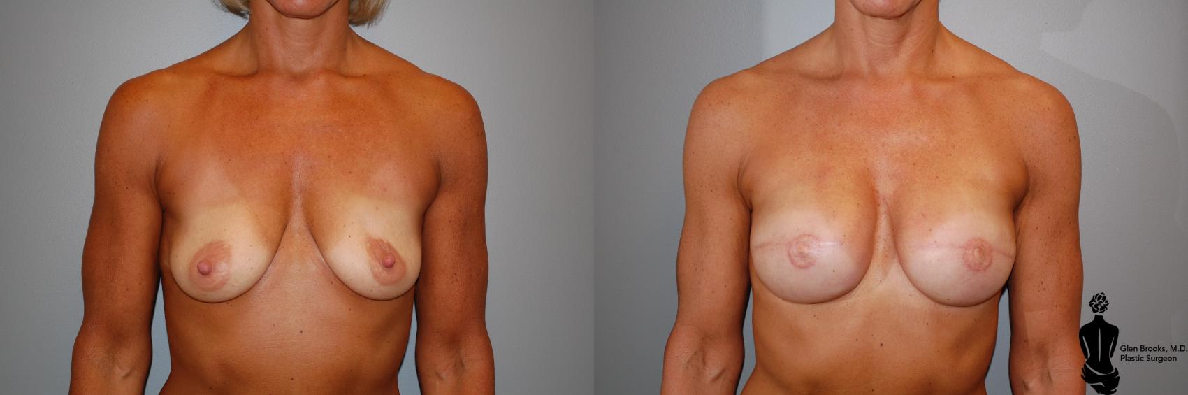 Before & After Breast Reconstruction Case 94 View #1 View in Springfield, MA