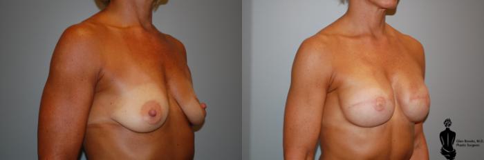 Before & After Breast Reconstruction Case 94 View #2 View in Springfield, MA