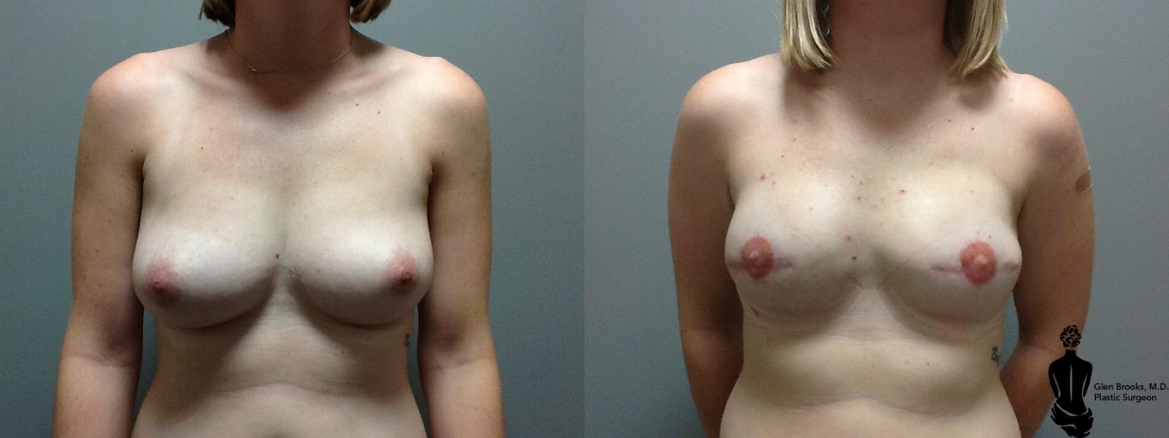 Before & After Breast Reconstruction Case 96 View #1 View in Springfield, MA