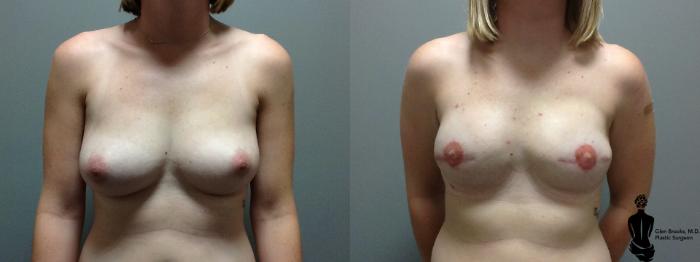 Before & After Breast Reconstruction Case 96 View #1 View in Springfield, MA