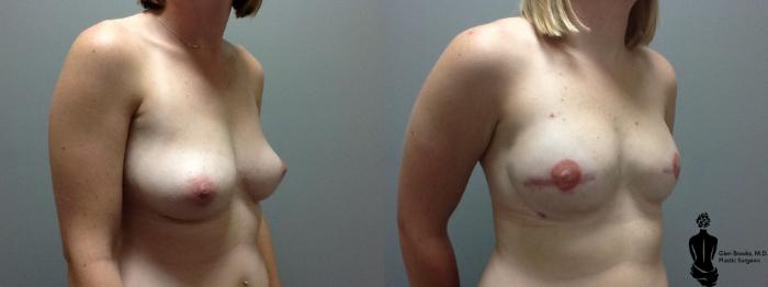 Before & After Breast Reconstruction Case 96 View #2 View in Springfield, MA
