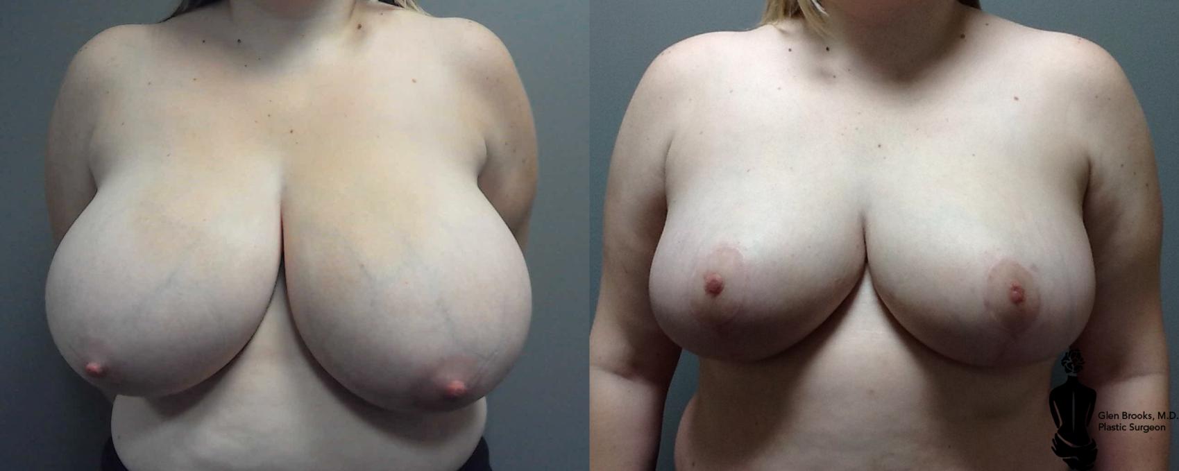 Before & After Breast Reduction Case 120 View #1 View in Springfield, MA