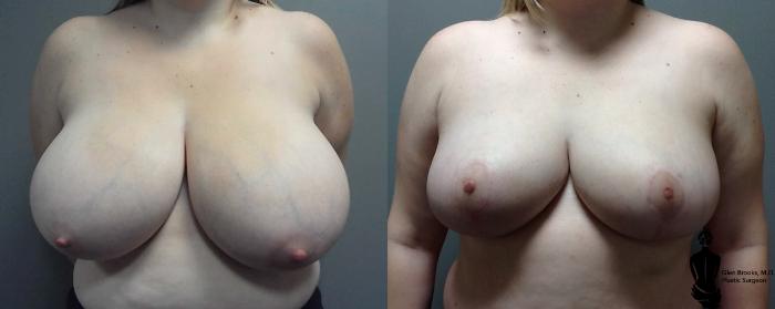 Before & After Breast Reduction Case 120 View #1 View in Springfield, MA