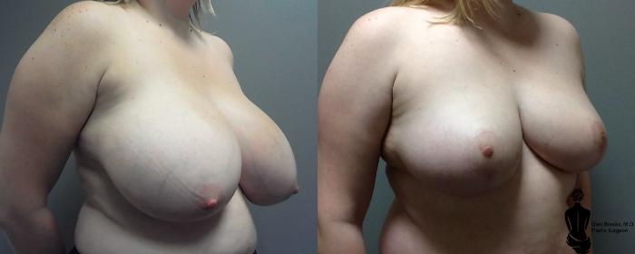 Before & After Breast Reduction Case 120 View #2 View in Springfield, MA
