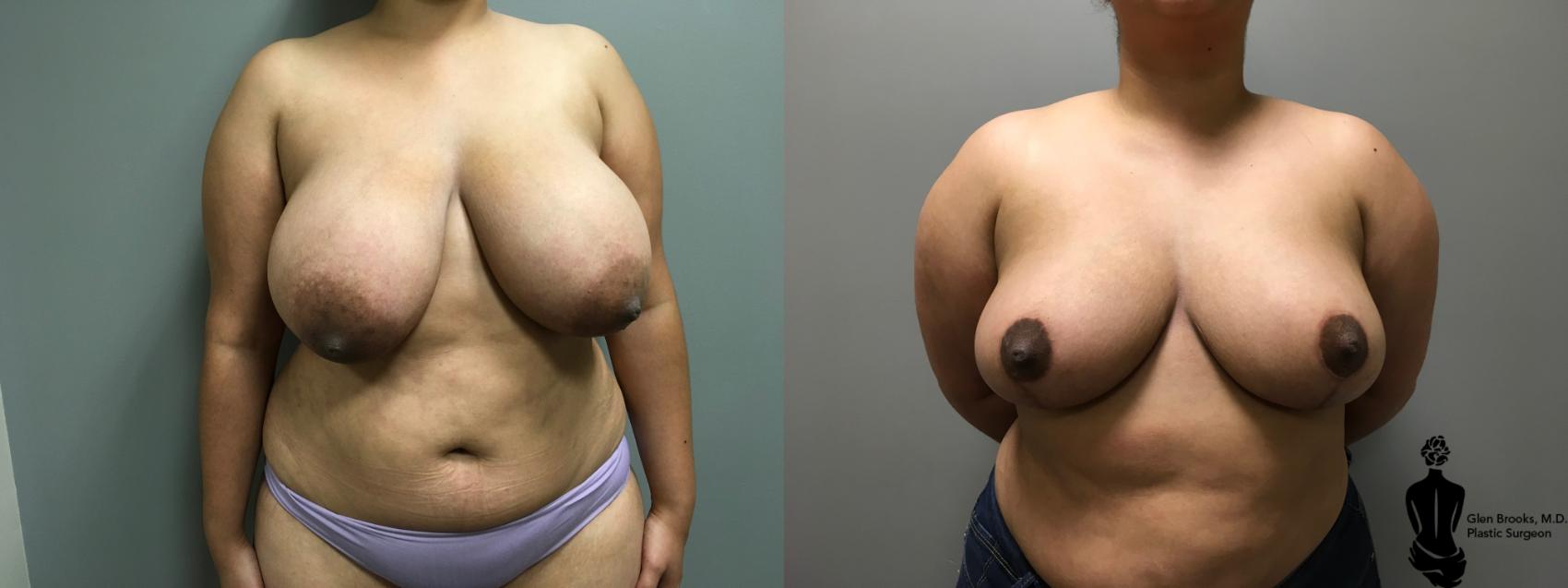 Before & After Breast Reduction Case 139 View #1 View in Springfield, MA