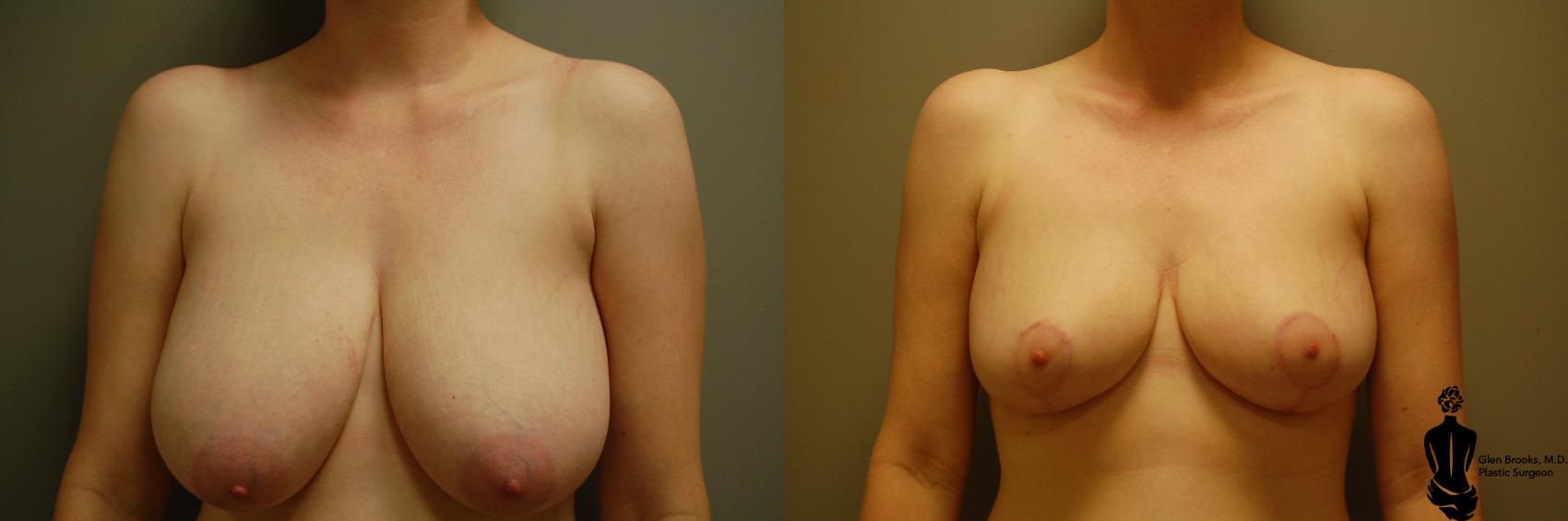 Before & After Breast Reduction Case 22 View #1 View in Springfield, MA