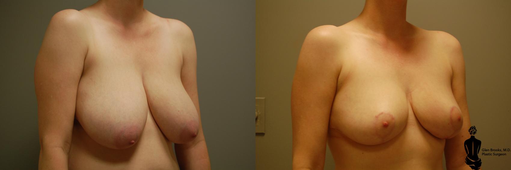 Before & After Breast Reduction Case 22 View #2 View in Springfield, MA
