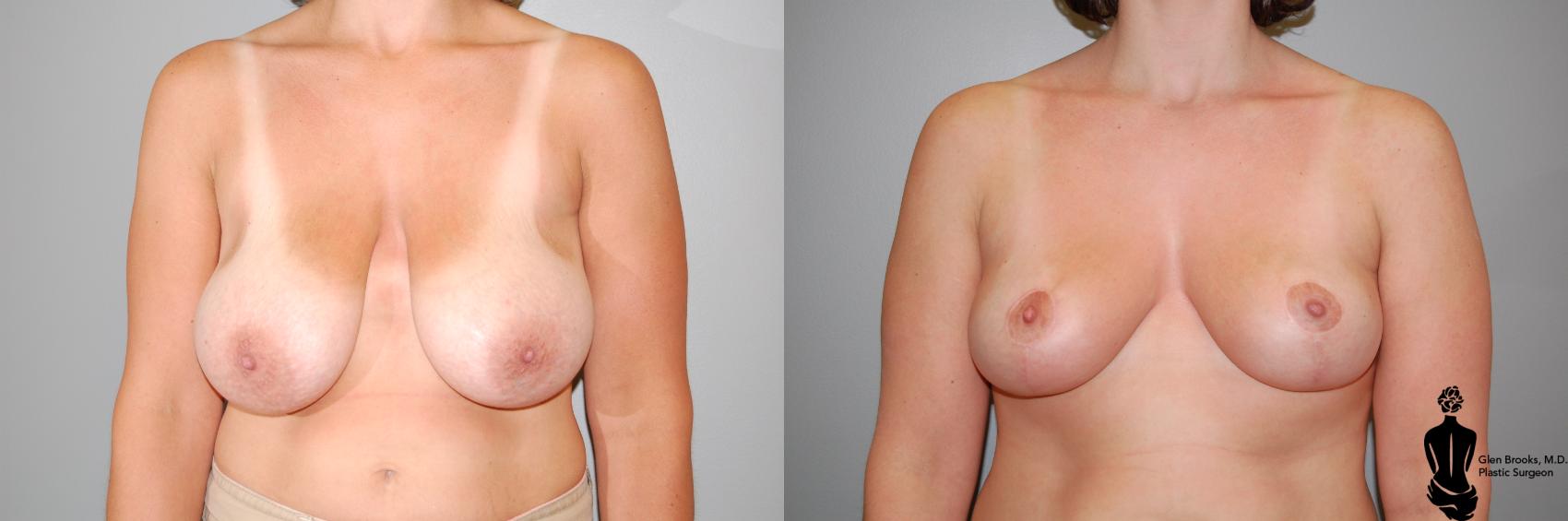 Before & After Breast Reduction Case 23 View #1 View in Springfield, MA