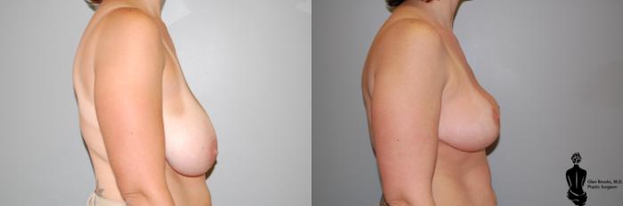 Before & After Breast Reduction Case 23 View #2 View in Springfield, MA