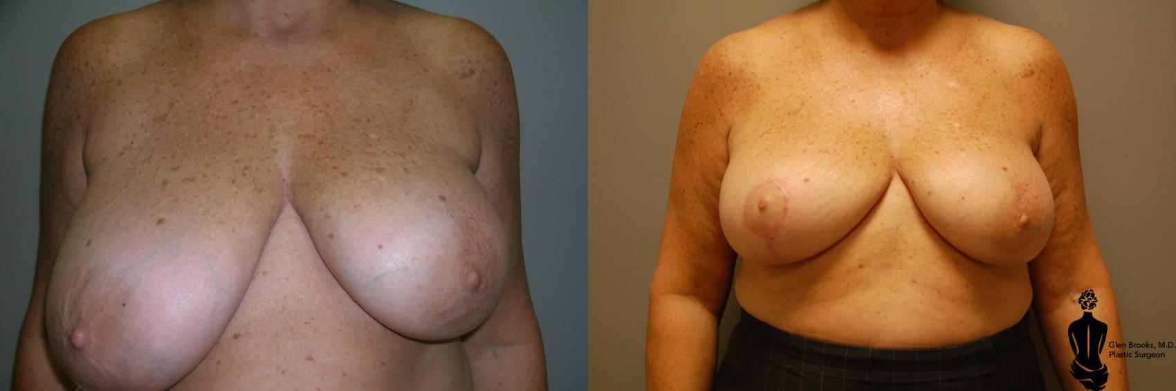 Breast Reduction Before & After Photo | Springfield, MA | Aesthetic Plastic & Reconstructive Surgery