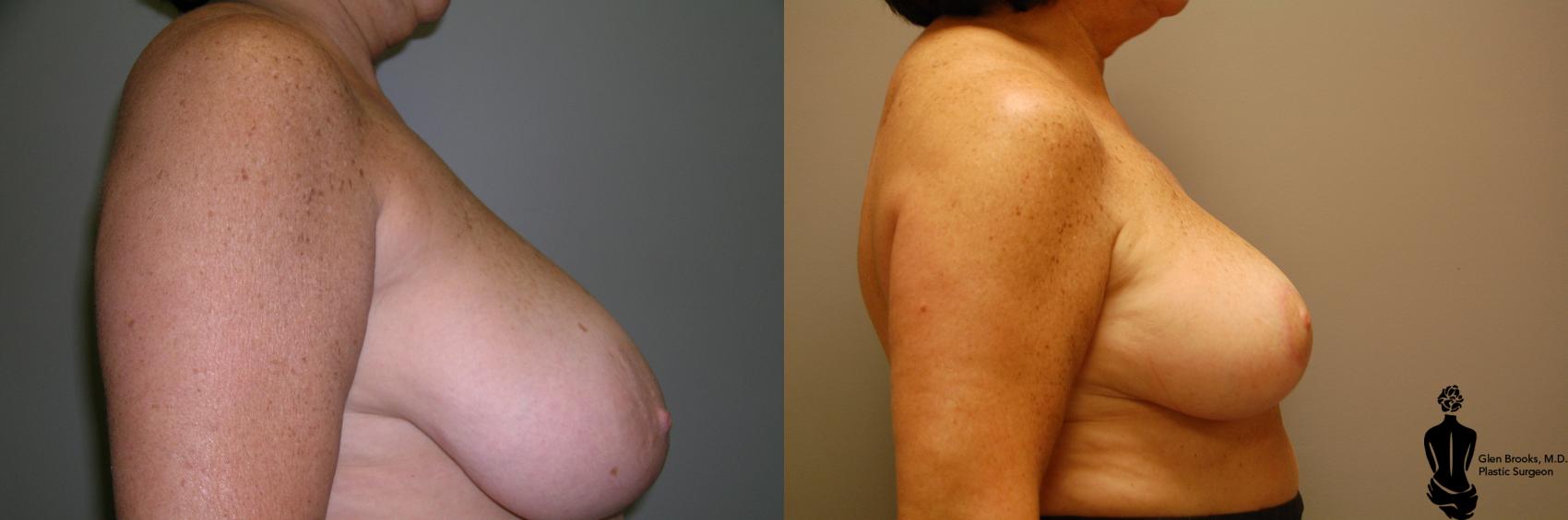 Breast Reduction Before & After Photo | Springfield, MA | Aesthetic Plastic & Reconstructive Surgery