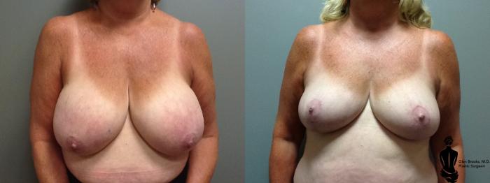 Before & After Breast Reduction Case 53 View #1 View in Springfield, MA