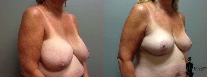 Before & After Breast Reduction Case 53 View #2 View in Springfield, MA