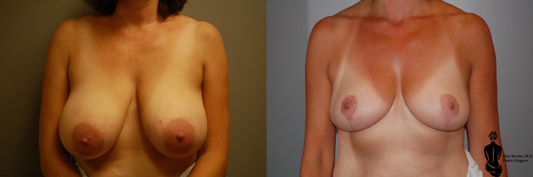 Before & After Breast Reduction Case 54 View #1 View in Springfield, MA