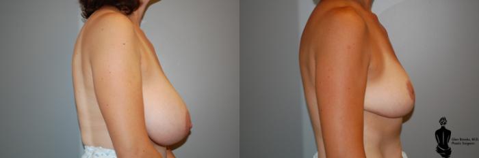 Before & After Breast Reduction Case 54 View #2 View in Springfield, MA