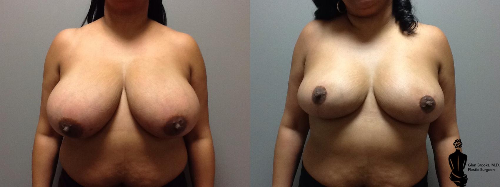 Before & After Breast Reduction Case 55 View #1 View in Springfield, MA