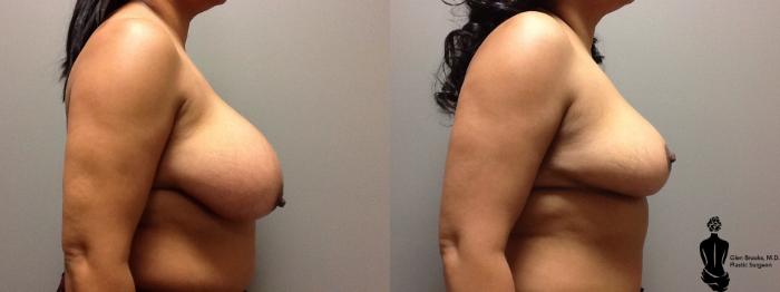 Before & After Breast Reduction Case 55 View #2 View in Springfield, MA