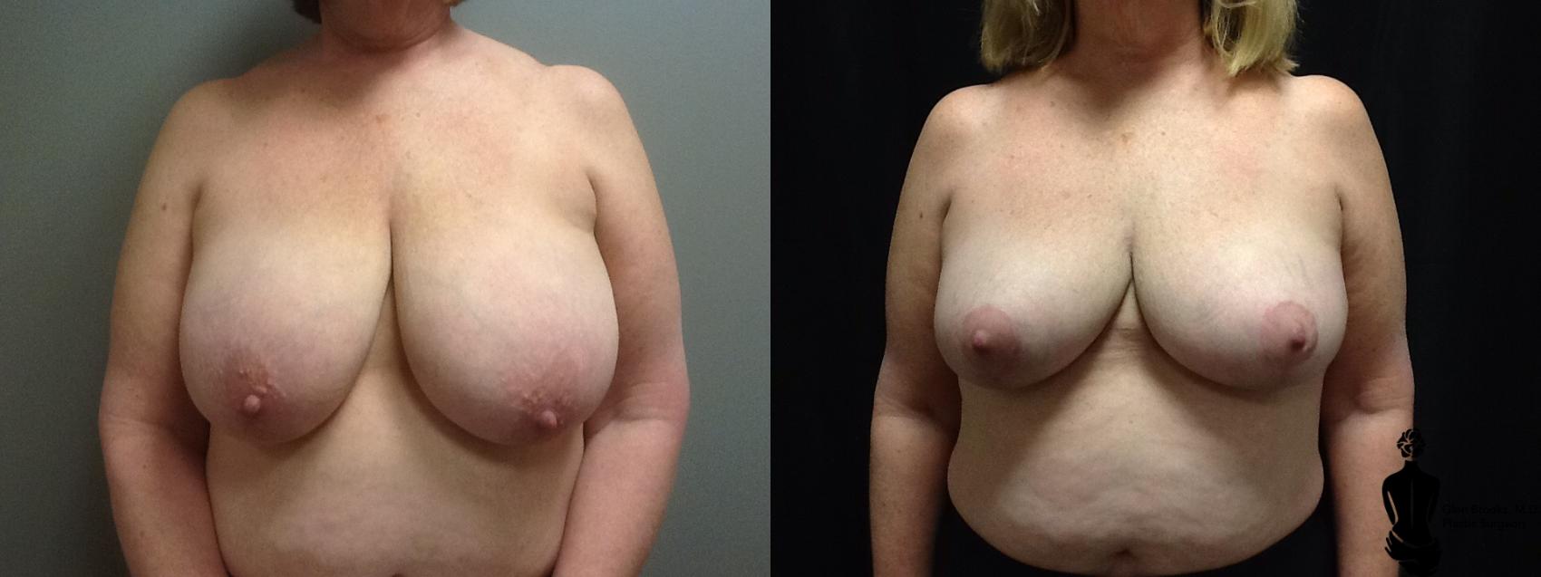 Before & After Breast Reduction Case 56 View #1 View in Springfield, MA
