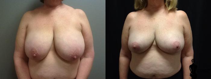 Before & After Breast Reduction Case 56 View #1 View in Springfield, MA