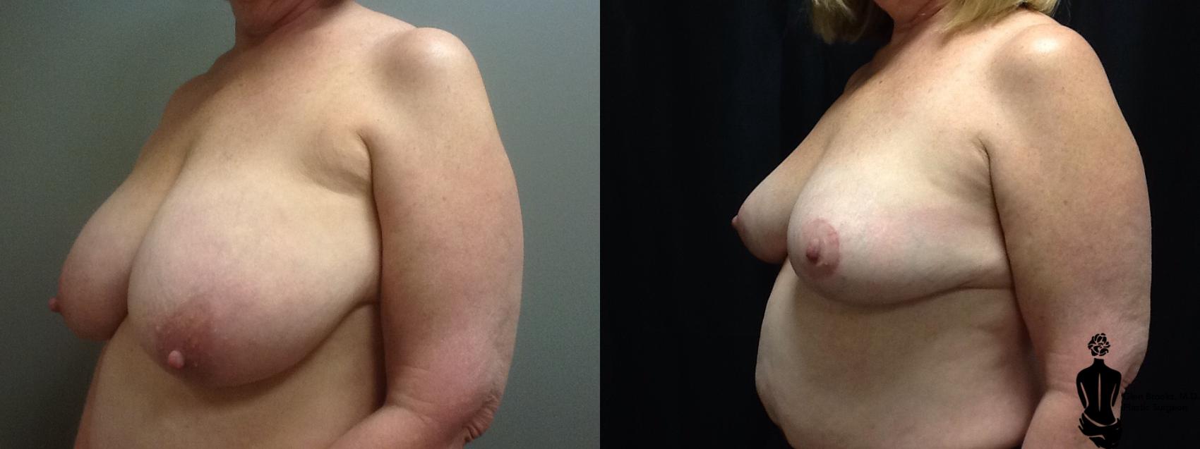 Before & After Breast Reduction Case 56 View #2 View in Springfield, MA