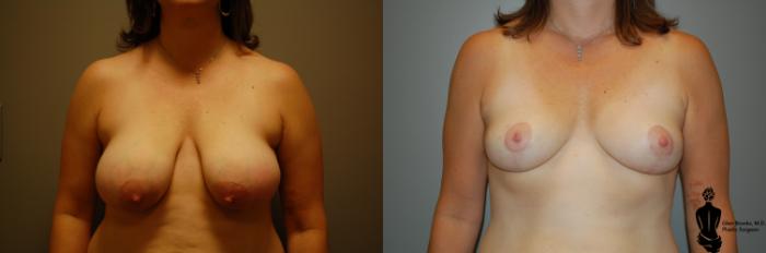 Before & After Breast Reduction Case 61 View #1 View in Springfield, MA