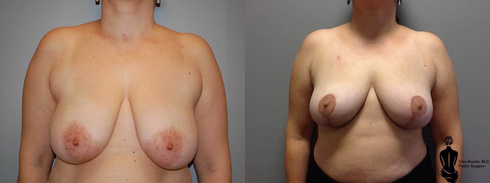 Before & After Breast Reduction Case 62 View #1 View in Springfield, MA