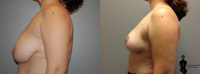 Before & After Breast Reduction Case 62 View #2 View in Springfield, MA