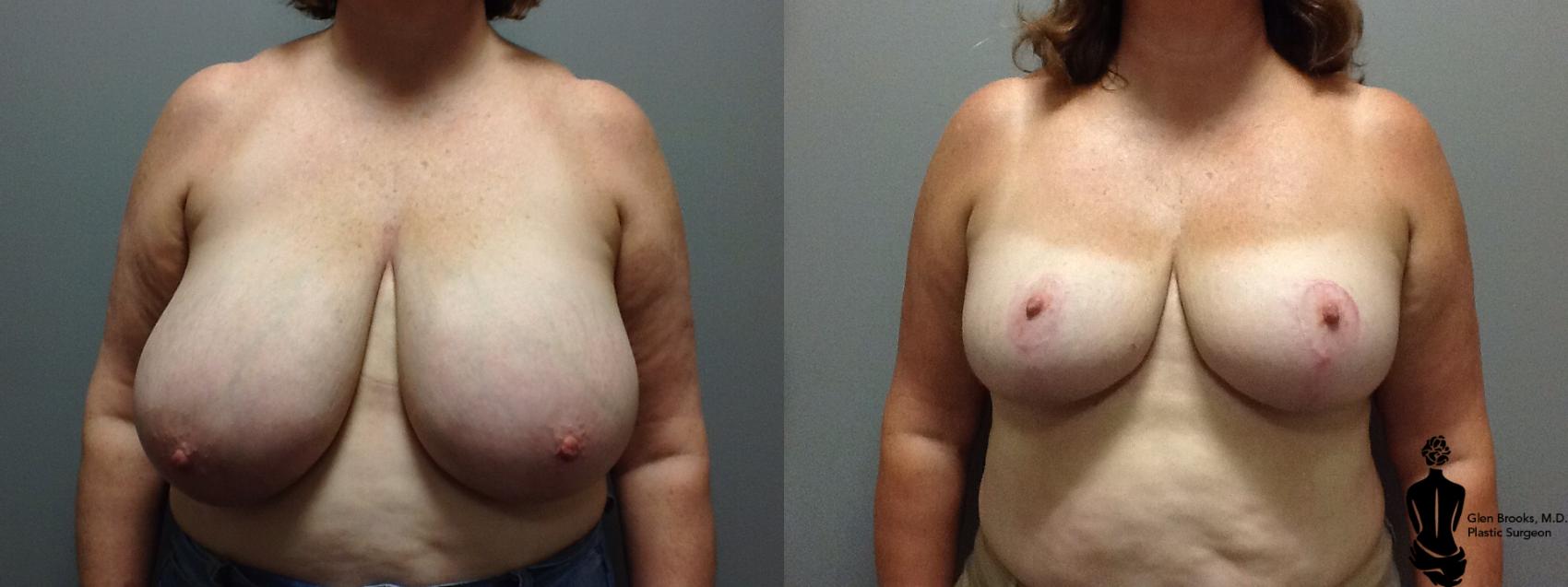 Before & After Breast Reduction Case 80 View #1 View in Springfield, MA