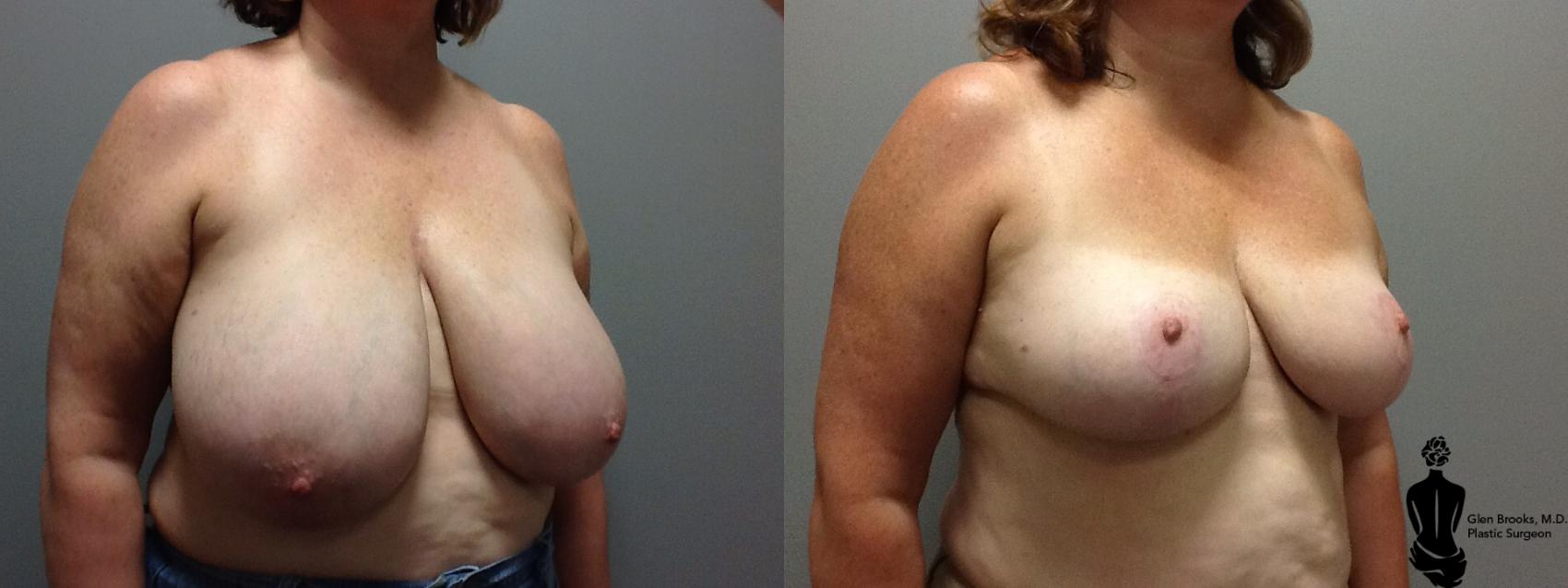 Before & After Breast Reduction Case 80 View #2 View in Springfield, MA