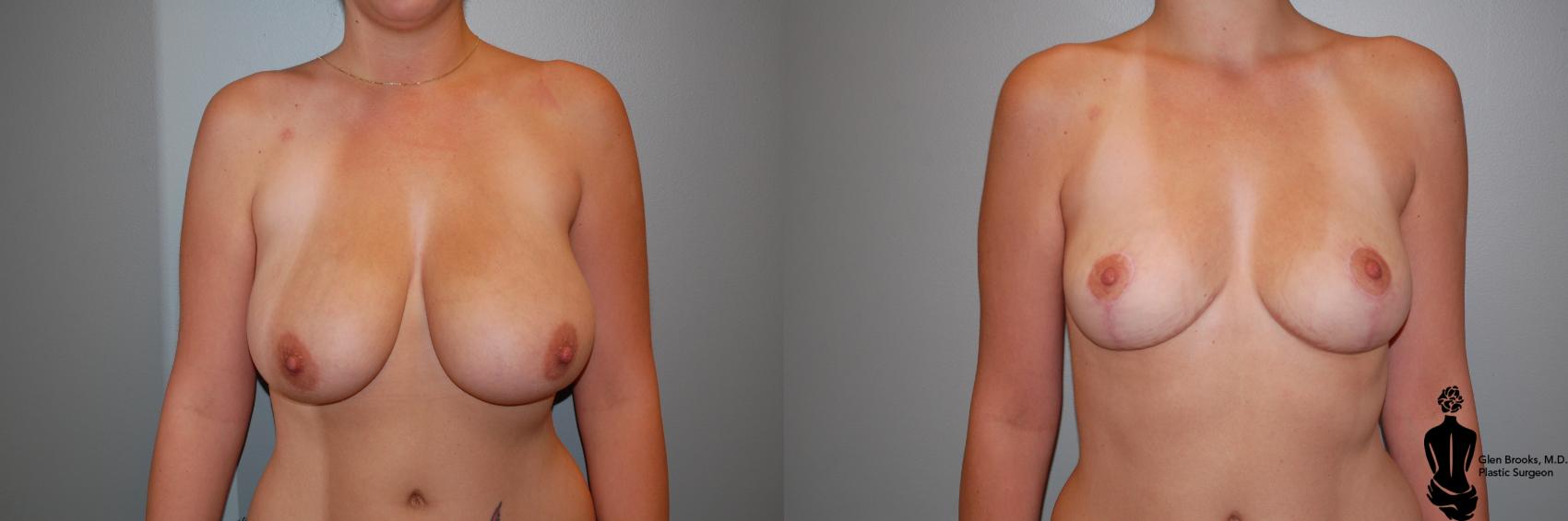 Before & After Breast Reduction Case 81 View #1 View in Springfield, MA