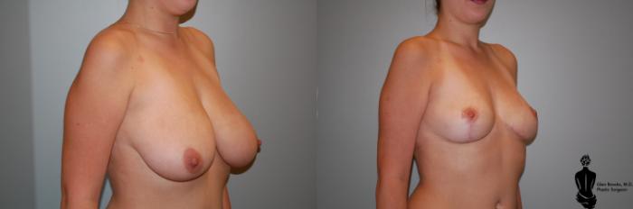 Before & After Breast Reduction Case 81 View #2 View in Springfield, MA