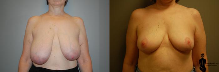 Before & After Breast Reduction Case 82 View #1 View in Springfield, MA