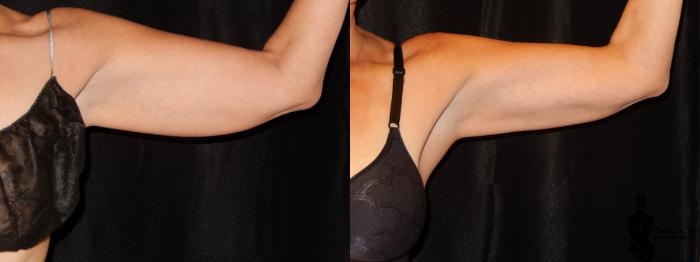 Before & After CoolSculpting Case 136 View #1 View in Springfield, MA