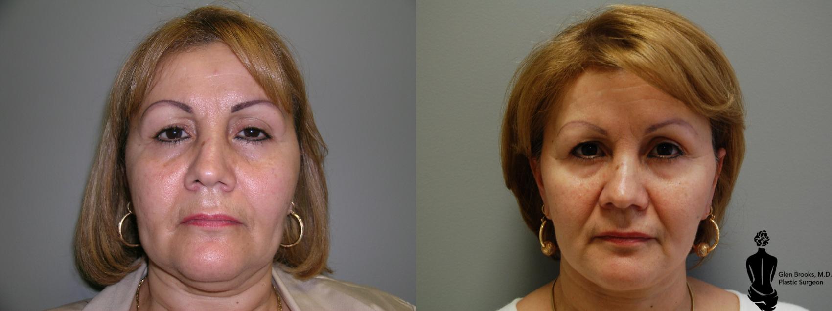 Before & After Face Lift Case 34 View #3 View in Springfield, MA